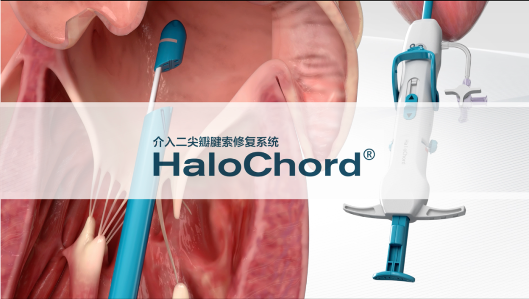 广东省人民医院刘健教授团队成功完成HaloChord®介入二尖瓣腱索修复系统临床应用
