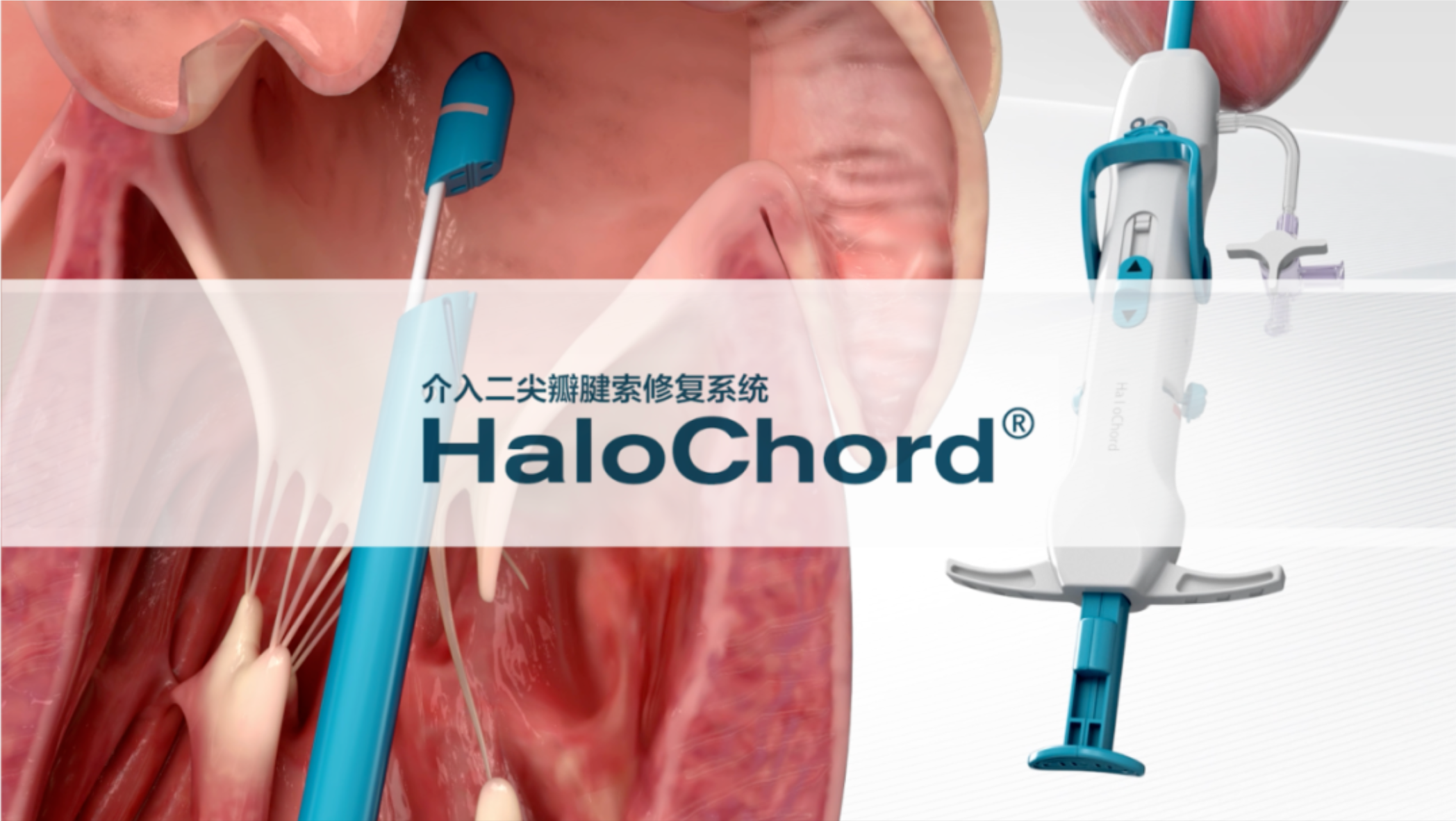 广东省人民医院刘健教授团队应用HaloChord®介入二尖瓣腱索修复系统完成Bentall术后患者二尖瓣腱索修复术