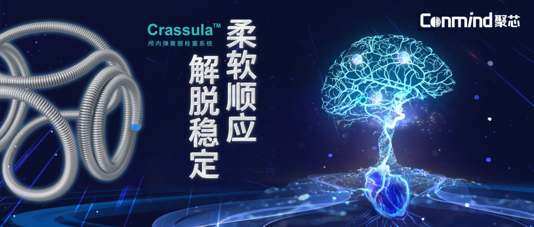 【聚汇医声】Crassula™弹簧圈治疗左侧大脑前交通动脉瘤一例